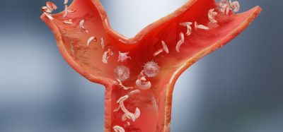 Stem cell therapy delivers potential for sickle cell disease