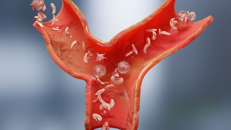 Stem cell therapy delivers potential for sickle cell disease