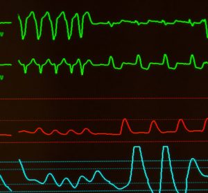 Tachycardia