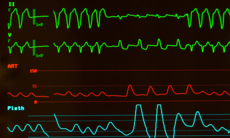 Tachycardia