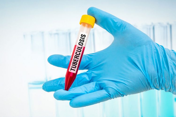 Blood test found to predict onset of TB up to two years in advance