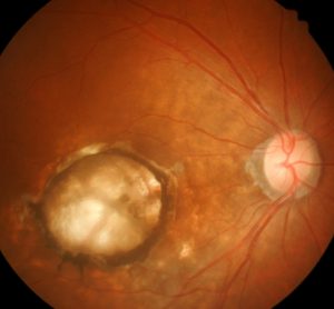 Wet AMD - brolucizumab