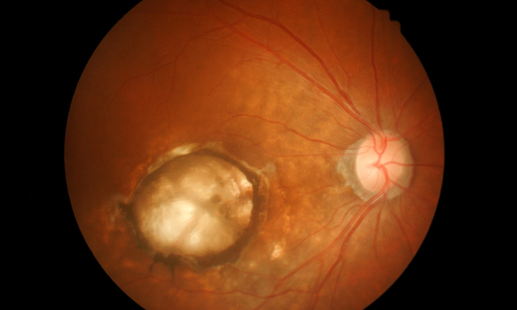 Wet AMD - brolucizumab