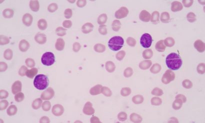 acute-myeloid-leukemia