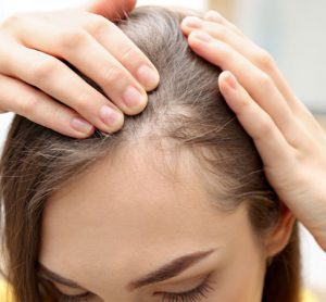 OLUMIANT drug for alopecia