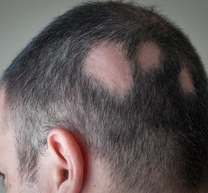 Man with alopecia areata - three bold spots on the side of his scalp/head