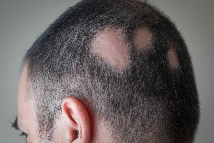 Man with alopecia areata - three bold spots on the side of his scalp/head