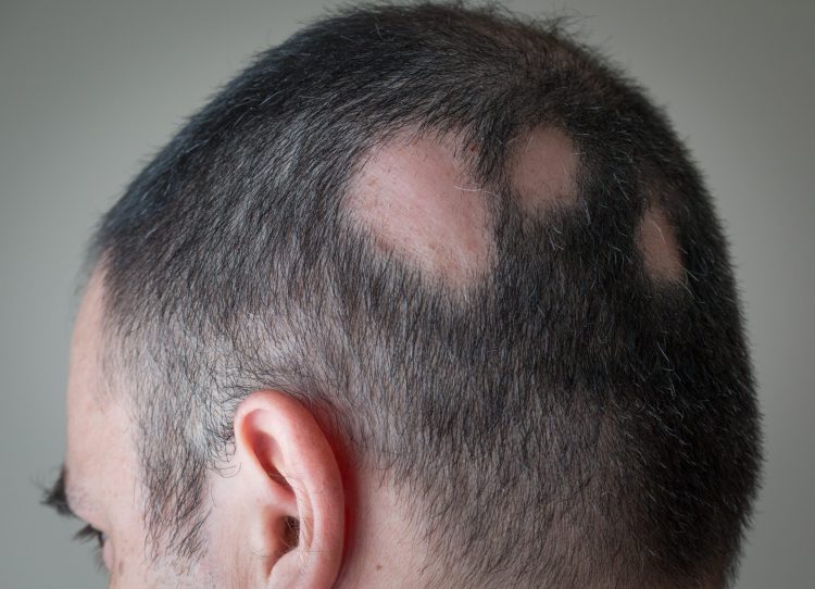 Man with alopecia areata - three bold spots on the side of his scalp/head