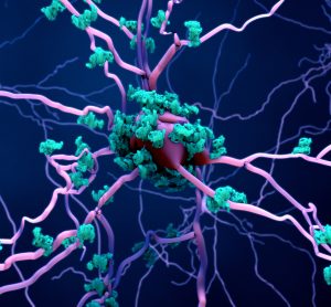 purple neuron surrounded by blue amyloid deposits