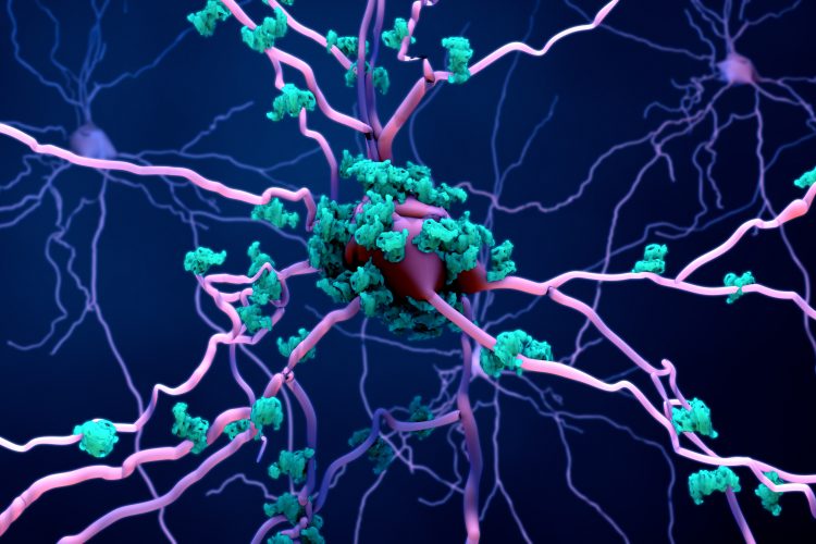 purple neuron surrounded by blue amyloid deposits