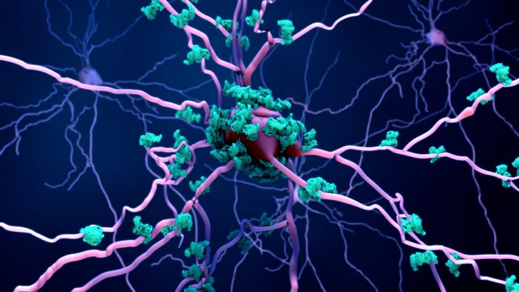 purple neuron surrounded by blue amyloid deposits