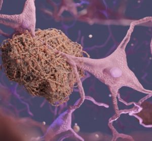 3 dimensional render of amyloid plaque found in the brain of Alzheimer's patients