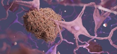 3 dimensional render of amyloid plaque found in the brain of Alzheimer's patients