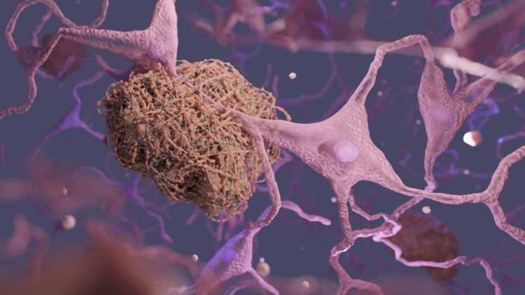 3 dimensional render of amyloid plaque found in the brain of Alzheimer's patients