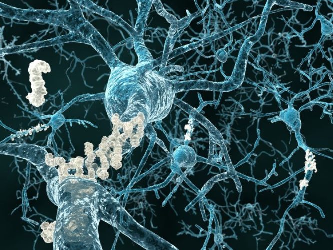 neurons with amyloid plaques concept