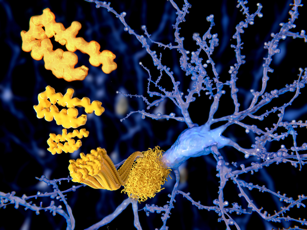 anti-amyloid treatment