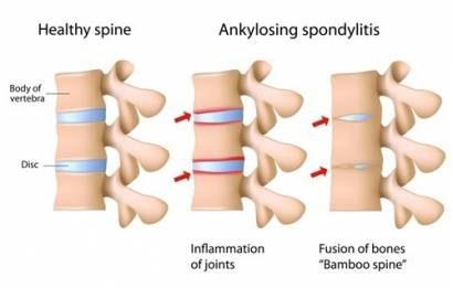 ankylosing spondylitis