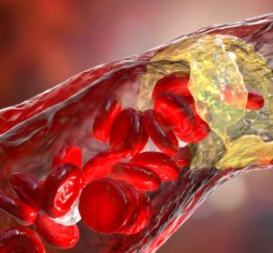 First adult anti-inflammatory cardiovascular drug approved