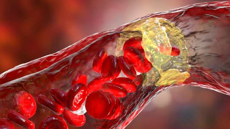 First adult anti-inflammatory cardiovascular drug approved