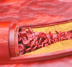 3D rendering of a fatty deposit preventing red blood cells from flowing in a blood vessel - idea of atherosclerosis