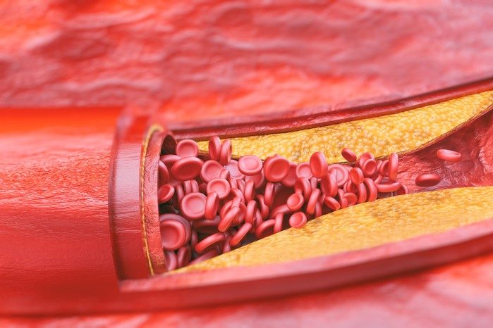 3D rendering of a fatty deposit preventing red blood cells from flowing in a blood vessel - idea of atherosclerosis