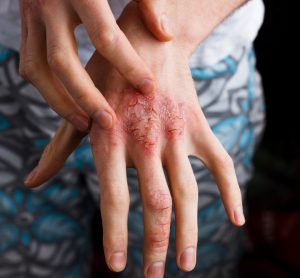 close up of a person's hand with atopic dermatitis lesions