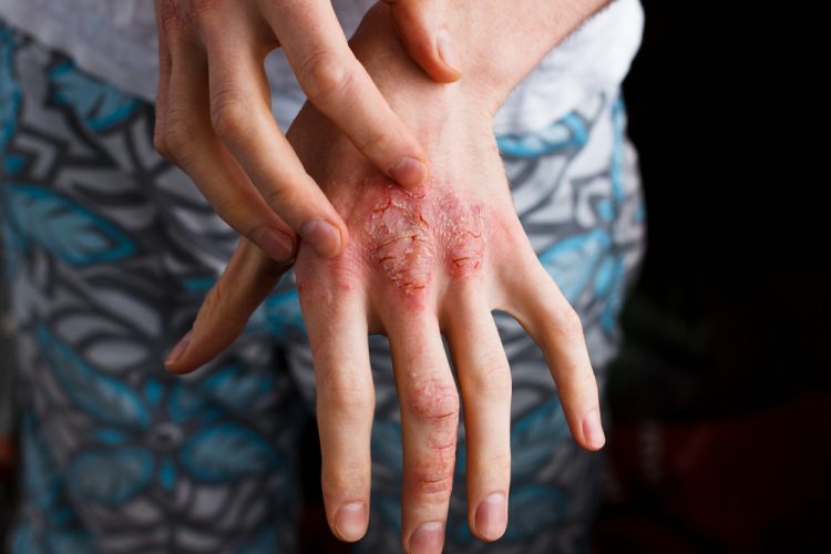 close up of a person's hand with atopic dermatitis lesions