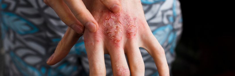close up of a person's hand with atopic dermatitis lesions