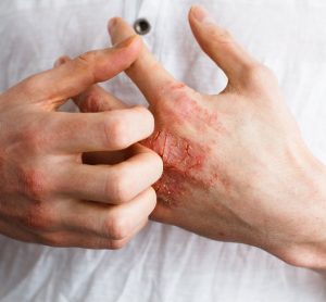 eczema