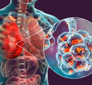 bacterial pneumonia