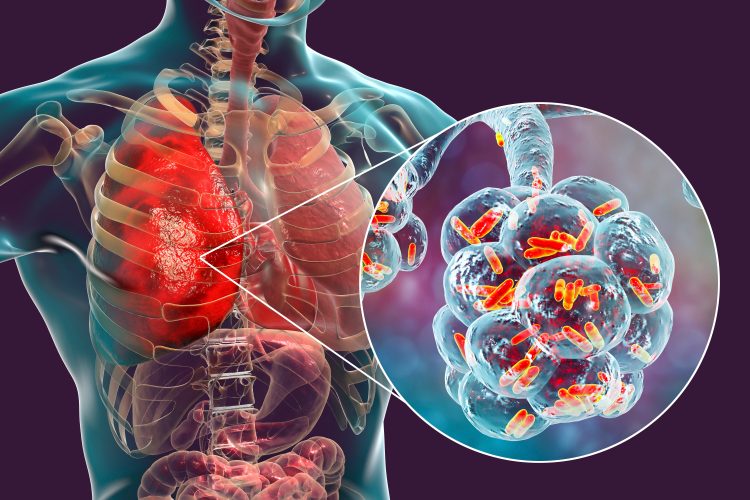 bacterial pneumonia