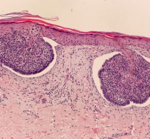 Microscopic view of basal cell carcinoma