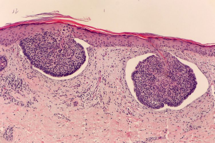 Microscopic view of basal cell carcinoma