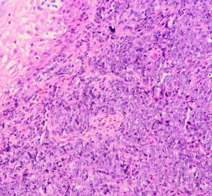 B-cell lymphoma