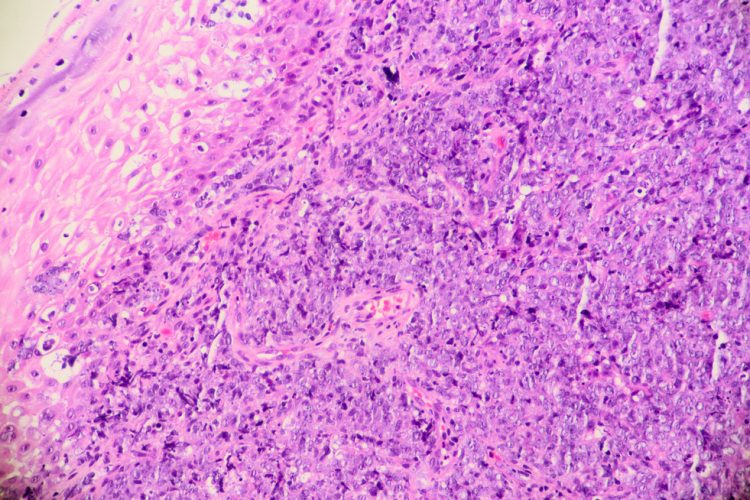 B-cell lymphoma