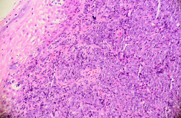 B-cell lymphoma