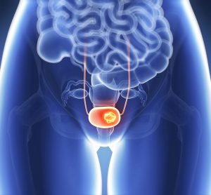 orange bladder with brighter orange lump - suggesting bladder cancer