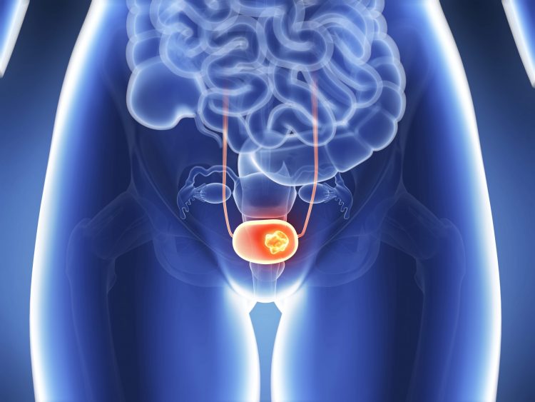 orange bladder with brighter orange lump - suggesting bladder cancer