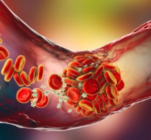 3D illustration of a Blood clot made of red blood cells, platelets and fibrin protein strands within a blood vessel