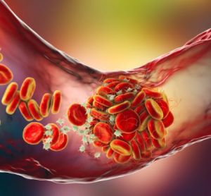 3D illustration of a Blood clot made of red blood cells, platelets and fibrin protein strands within a blood vessel