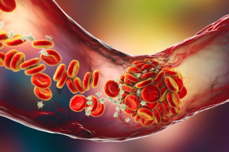 3D illustration of a Blood clot made of red blood cells, platelets and fibrin protein strands within a blood vessel