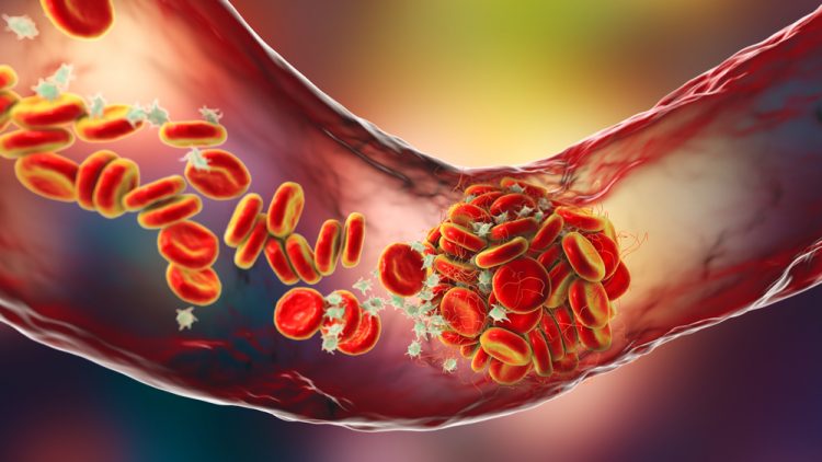 3D illustration of a Blood clot made of red blood cells, platelets and fibrin protein strands within a blood vessel
