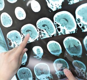 finger pointing to a series of MRI images of the brain - idea of neurological condition, such as multiple sclerosis