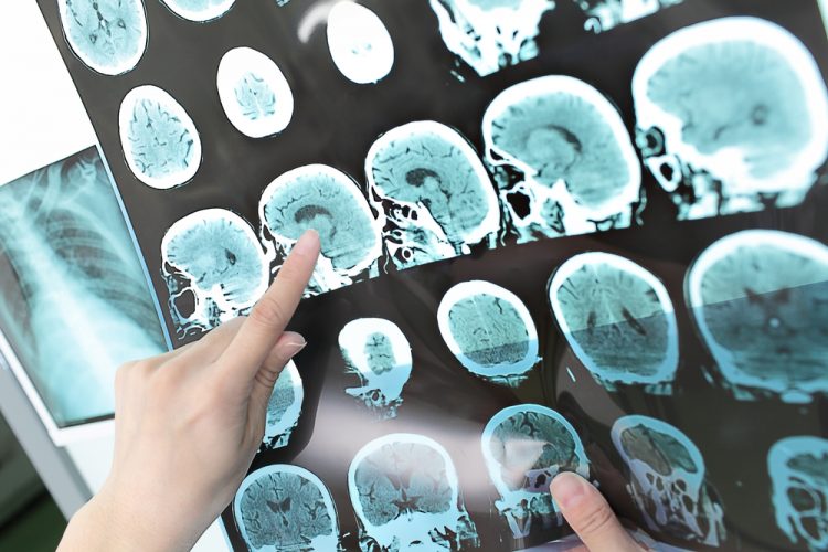 finger pointing to a series of MRI images of the brain - idea of neurological condition, such as multiple sclerosis