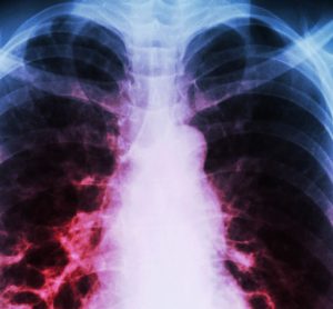 chronic lung disease