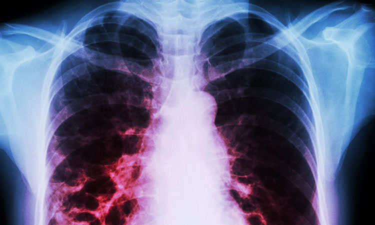 chronic lung disease