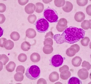 Blood smear under microscopy showing chronic lymphoblastic leukemia (CLL)