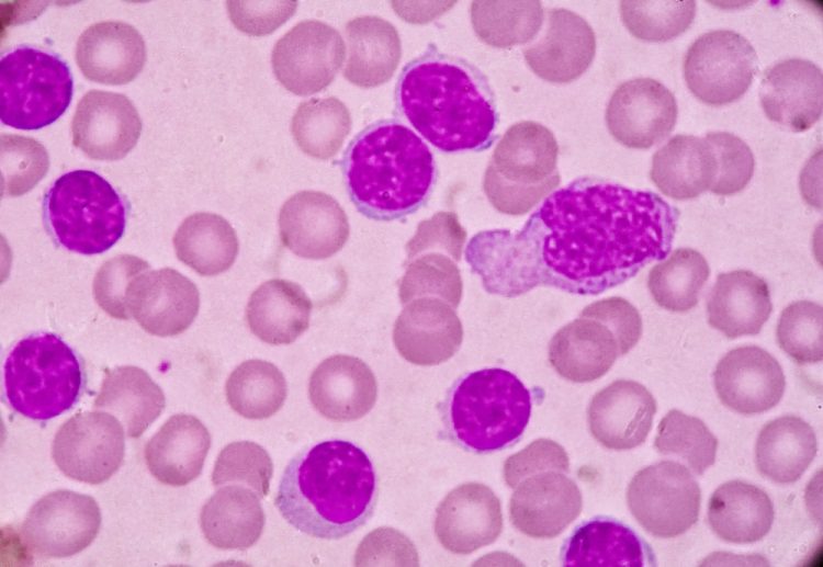 Blood smear under microscopy showing chronic lymphoblastic leukemia (CLL)