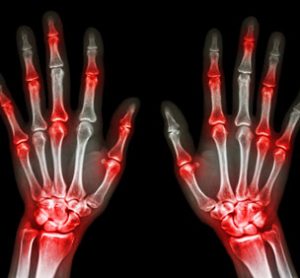 cimzia arthritis x-ray hands bones