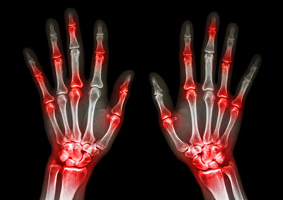 cimzia arthritis x-ray hands bones